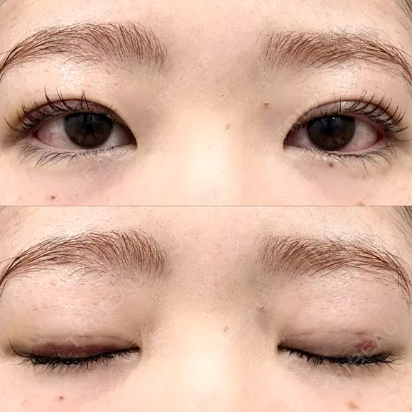 二重埋没 湘南美容クリニック 博多院 DAY 13 メイン用