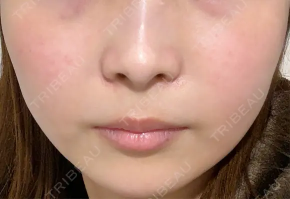 その他（輪郭） / 医療痩身（顔） / その他（肌） / RF（高周波）たるみ治療 / オンダリフト ライブリークリニック 船橋院 DAY 20 メイン用