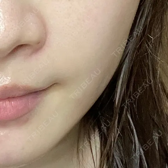 ヒアルロン酸溶解 EOL CLINIC【オルクリニック】 AFTER メイン用