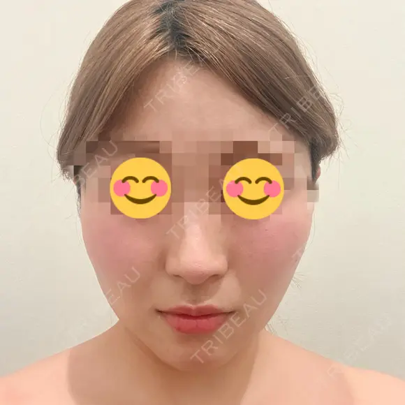 糸リフト / バッカルファット除去 / 脂肪吸引（顔） / ボトックス（あご） / ボトックス（エラ・小顔） アリエル美容クリニック 水戸院 AFTER メイン用