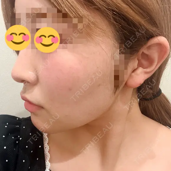 糸リフト / バッカルファット除去 / 脂肪吸引（顔） / ボトックス（あご） / ボトックス（エラ・小顔） アリエル美容クリニック 水戸院 DAY 196 メイン用
