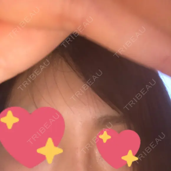 ヒアルロン酸注入（鼻） 広島プルミエクリニック DAY 0 メイン用