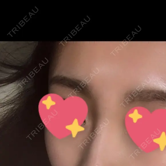 ヒアルロン酸注入（鼻） 広島プルミエクリニック DAY 0 メイン用