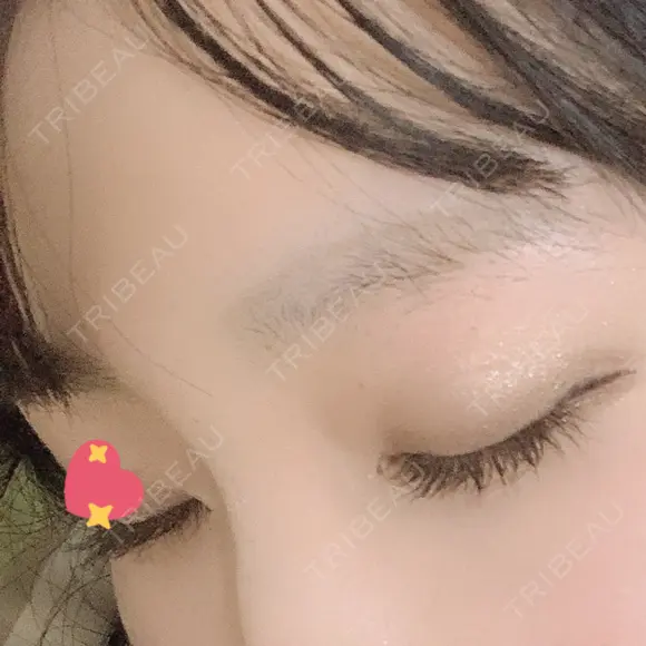 ヒアルロン酸注入（鼻） 広島プルミエクリニック DAY 1 メイン用