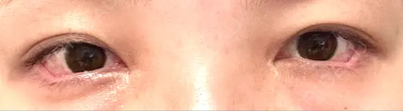 目尻切開 / タレ目形成・グラマラスライン（埋没） LOUIS CLINIC 二子玉川院【ルイクリニック】 DAY 2 メイン用