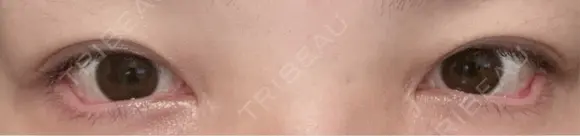 目尻切開 / タレ目形成・グラマラスライン（埋没） LOUIS CLINIC 二子玉川院【ルイクリニック】 DAY 3 メイン用