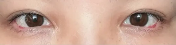 目尻切開 / タレ目形成・グラマラスライン（埋没） LOUIS CLINIC 二子玉川院【ルイクリニック】 DAY 5 メイン用