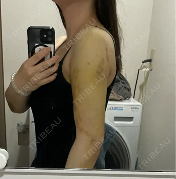 脂肪吸引（二の腕） / 豊胸（脂肪注入） / 脂肪吸引（肩） Lipo Clinic omotesando DAY 10 メイン用