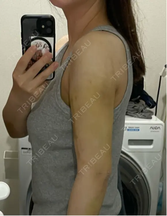 脂肪吸引（二の腕） / 豊胸（脂肪注入） / 脂肪吸引（肩） Lipo Clinic omotesando DAY 13 メイン用