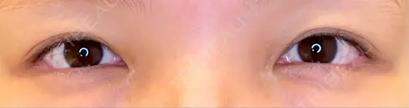 目尻切開 / タレ目形成・グラマラスライン（埋没） LOUIS CLINIC 二子玉川院【ルイクリニック】 AFTER メイン用
