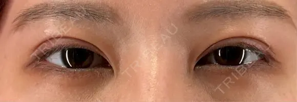二重切開 / 眼瞼下垂（切開） eクリニック 大阪院 AFTER メイン用