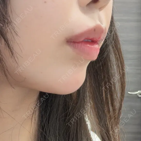 ヒアルロン酸注入（あご） / ヒアルロン酸注入（唇） 新未来クリニック DAY 0 メイン用