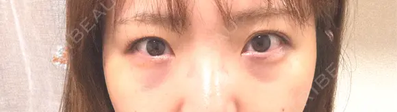 下まぶたの脂肪取り 聖心美容クリニック 福岡院 DAY 0 メイン用