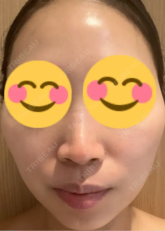 医療脱毛（顔） ルラライト美容クリニック 八王子院 DAY 0 メイン用