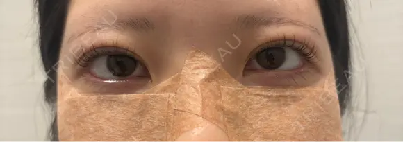 クマ治療 R Beauty CLINIC 名古屋院 AFTER メイン用