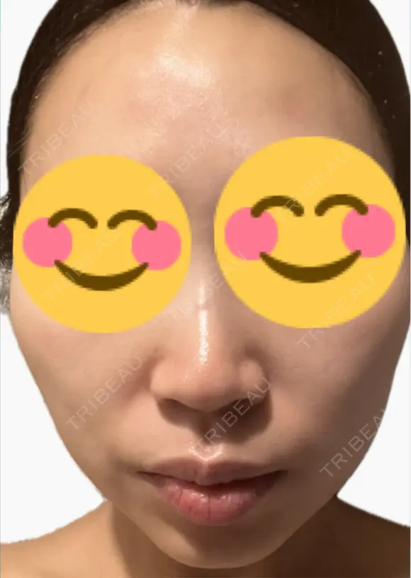 医療脱毛（顔） ルラライト美容クリニック 八王子院 DAY 1 メイン用