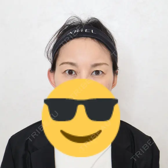 クマ治療 アリエル美容クリニック 横浜院 AFTER メイン用