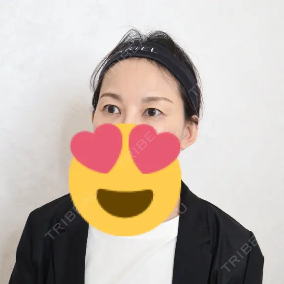 クマ治療 アリエル美容クリニック 横浜院 DAY 96 メイン用