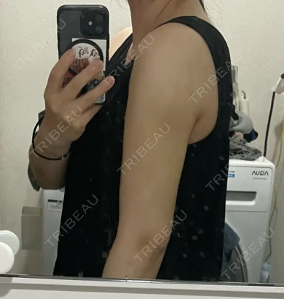 脂肪吸引（二の腕） / 豊胸（脂肪注入） / 脂肪吸引（肩） Lipo Clinic omotesando DAY 16 メイン用