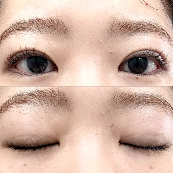 二重埋没 湘南美容クリニック 博多院 AFTER メイン用