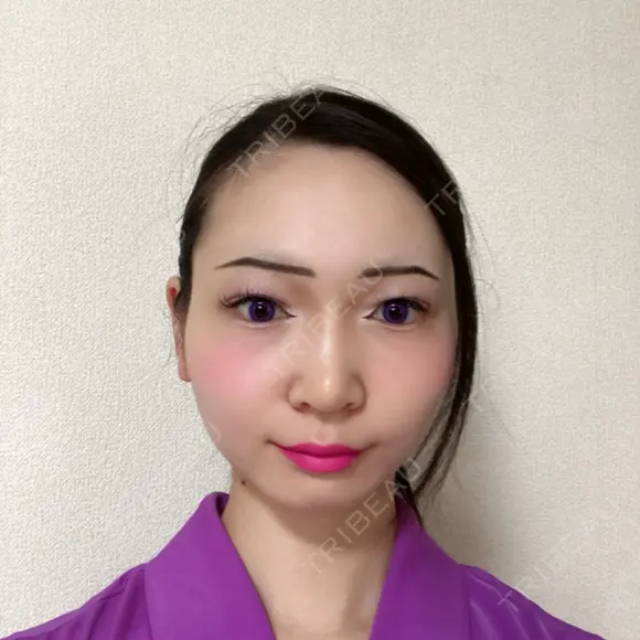 鼻尖形成（切開） / 小鼻縮小（切開） / 軟骨移植 / 鼻尖縮小 / 鼻孔縁下降 アリエル美容クリニック 郡山院 AFTER メイン用