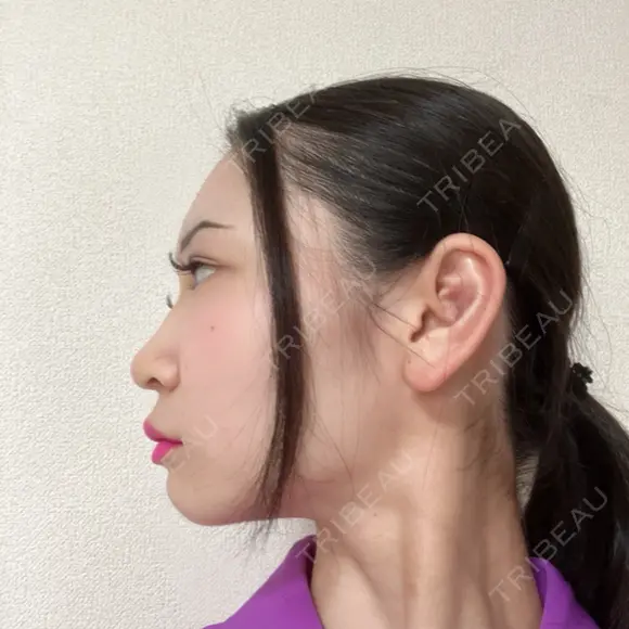 鼻尖形成（切開） / 小鼻縮小（切開） / 軟骨移植 / 鼻尖縮小 / 鼻孔縁下降 アリエル美容クリニック 郡山院 DAY 62 メイン用