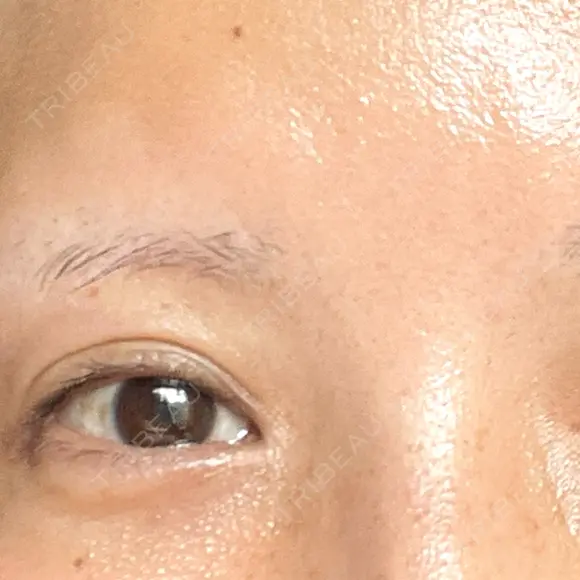 ヒアルロン酸溶解 EOL CLINIC【オルクリニック】 AFTER メイン用