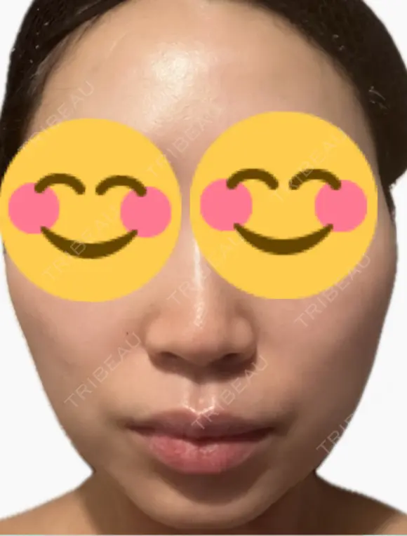 医療脱毛（顔） ルラライト美容クリニック 八王子院 AFTER メイン用