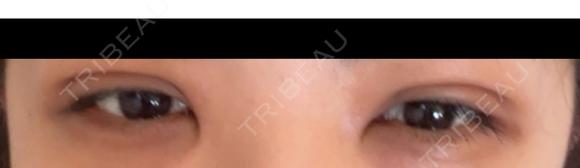 二重埋没 NARU Beauty Clinic 【ナルクリ】 DAY 3 メイン用