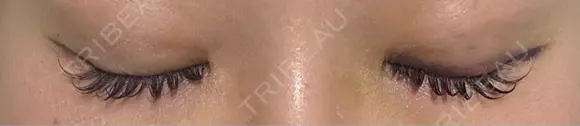 二重埋没 / 上まぶたの脂肪取り アリエル美容クリニック 大宮院 DAY 6 メイン用