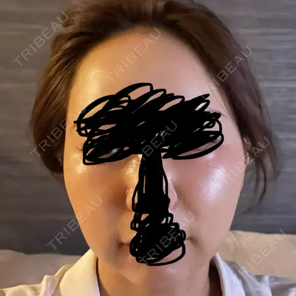 メーラーファット除去 / ジョールファット除去 R Beauty CLINIC 名古屋院 AFTER メイン用