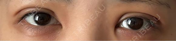 二重埋没 NARU Beauty Clinic 【ナルクリ】 DAY 4 メイン用