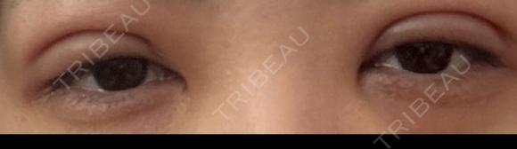 二重埋没 NARU Beauty Clinic 【ナルクリ】 DAY 2 メイン用