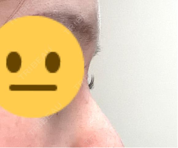 その他（鼻） ASTRA BEAUTY CLINIC DAY 8 メイン用