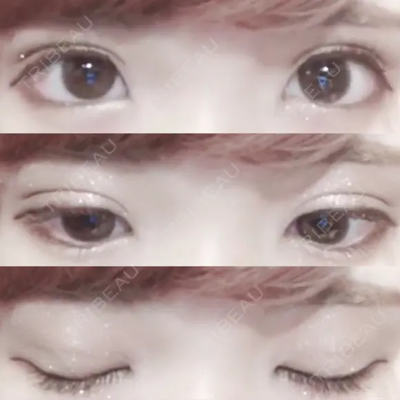 二重埋没 湘南美容クリニック 長野院 DAY 16 メイン用