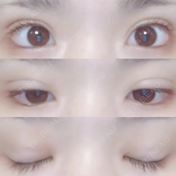 二重埋没 湘南美容クリニック 長野院 DAY 16 メイン用