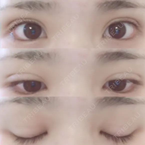 二重埋没 湘南美容クリニック 長野院 DAY 17 メイン用