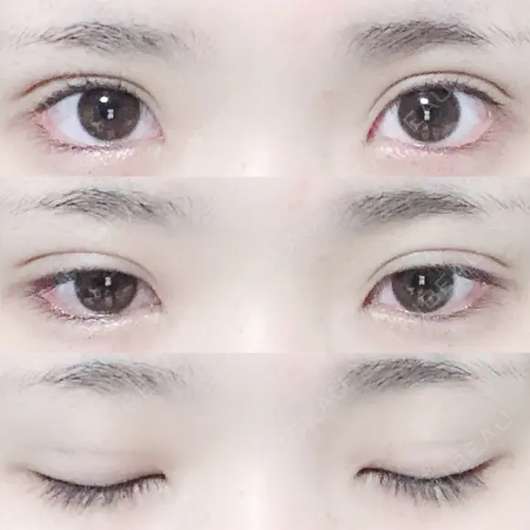 二重埋没 湘南美容クリニック 長野院 DAY 28 メイン用