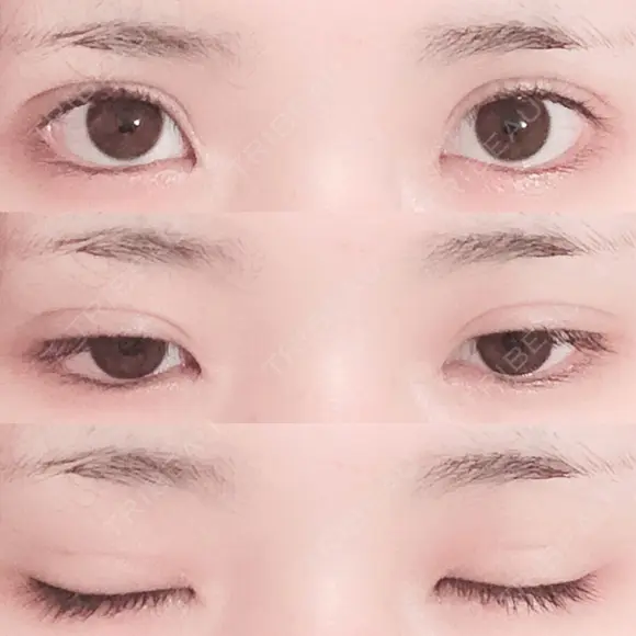 二重埋没 湘南美容クリニック 長野院 DAY 32 メイン用