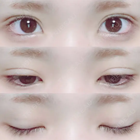 二重埋没 湘南美容クリニック 長野院 AFTER メイン用