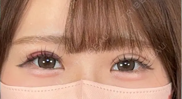二重埋没 / 上まぶたの脂肪取り アリエル美容クリニック 大宮院 DAY 9 メイン用