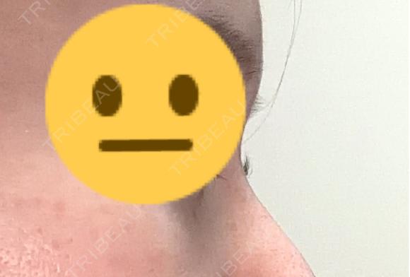 その他（鼻） ASTRA BEAUTY CLINIC DAY 16 メイン用