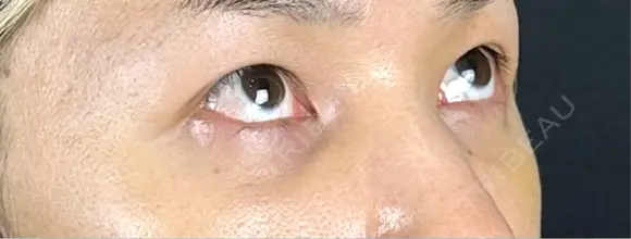 クマ治療 藤・ナチュレ美容クリニック 銀座院 DAY 10 メイン用