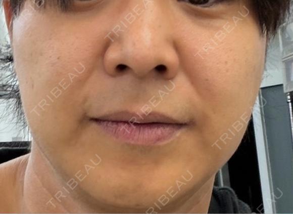 糸リフト / バッカルファット除去 / ボトックス（エラ・小顔） ルラ美容クリニック 札幌大通り院 AFTER メイン用