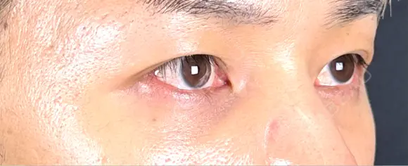 クマ治療 藤・ナチュレ美容クリニック 銀座院 DAY 30 メイン用