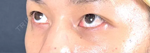 クマ治療 藤・ナチュレ美容クリニック 銀座院 DAY 30 メイン用