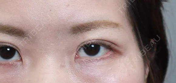 二重埋没 アリエル美容クリニック 大宮院 DAY 12 メイン用