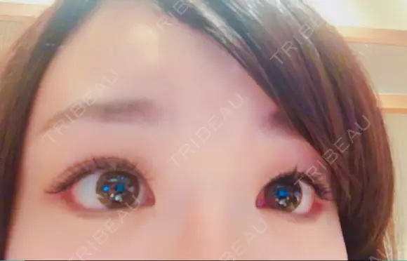 目尻切開 / タレ目形成・グラマラスライン（切開） シエルクリニック DAY 15 メイン用