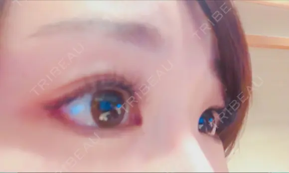 目尻切開 / タレ目形成・グラマラスライン（切開） シエルクリニック DAY 15 メイン用