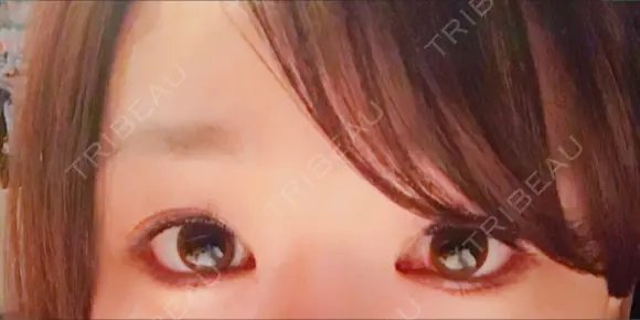 目尻切開 / タレ目形成・グラマラスライン（切開） シエルクリニック DAY 17 メイン用